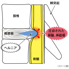 頚椎椎間板ヘルニア