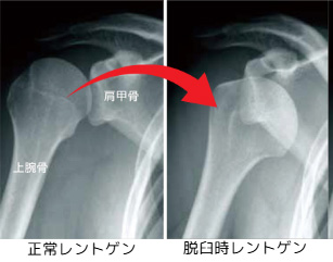 肩関節不安定症