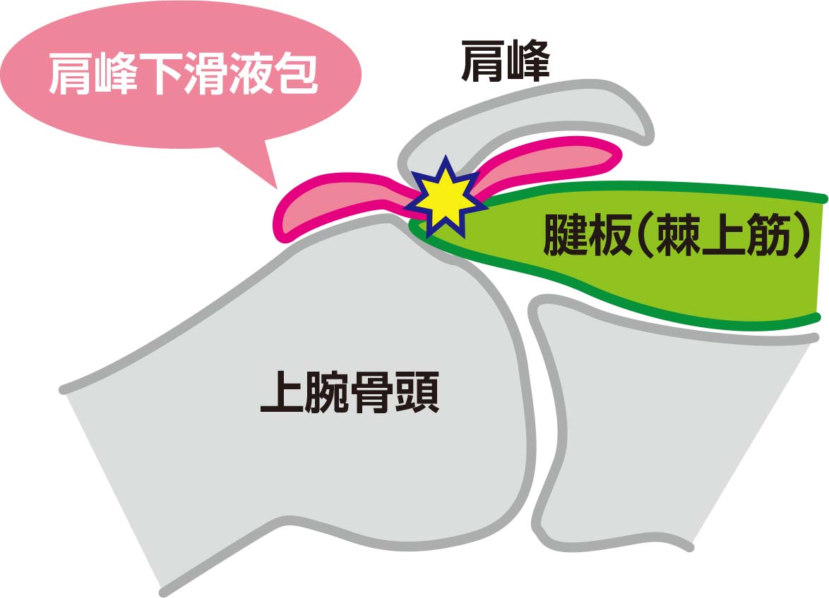 インピンジメント症候群