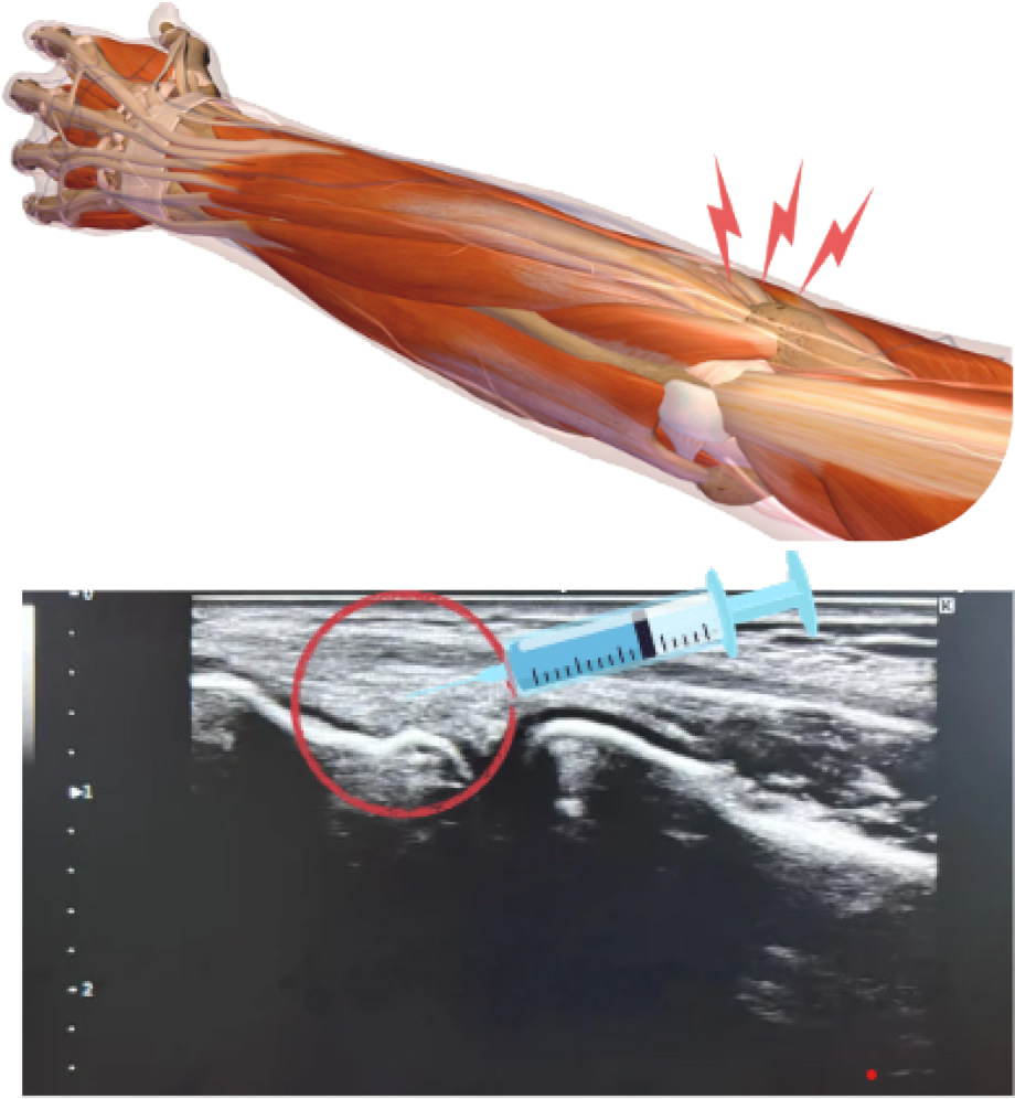 上腕骨外側上顆炎