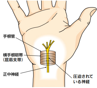手根管症候群