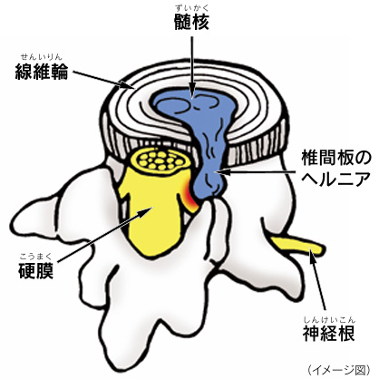 腰椎椎間板ヘルニア