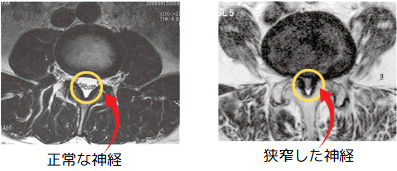 腰部脊柱管狭窄症