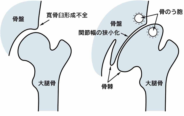 変形性股関節症