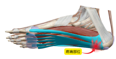 足底腱膜炎