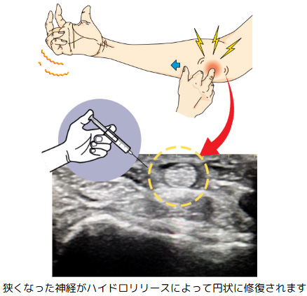 ハイドロリリース