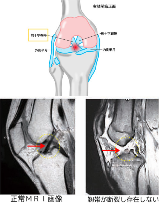 前十字靭帯損傷