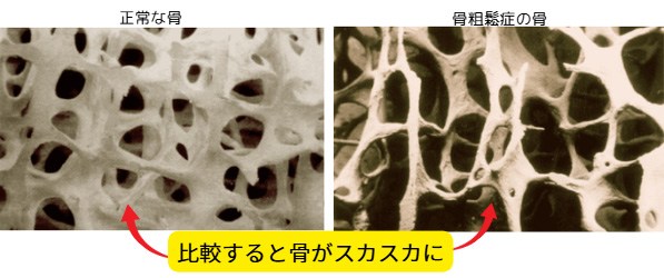 骨粗しょう症とは