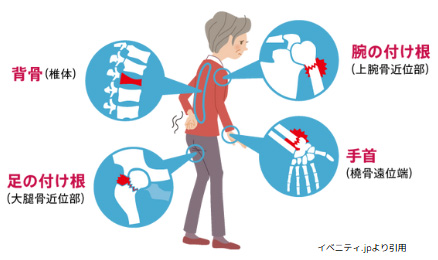 主な症状と骨折のリスク