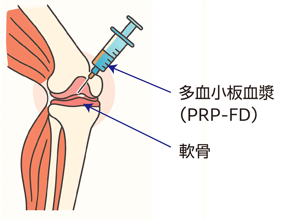 ハイドロリリース
