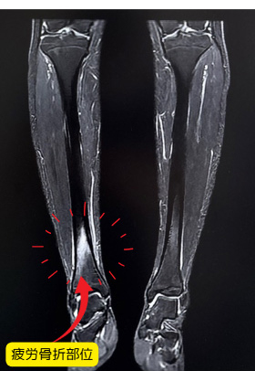 疲労骨折