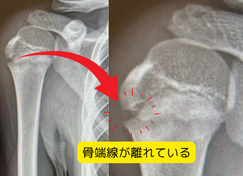 リトルリーガーズショルダー