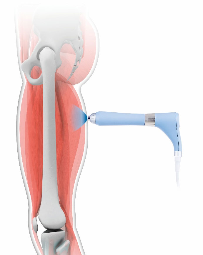 ハイドロリリース